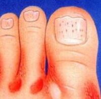 Hongo en los pies