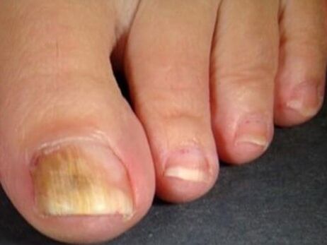 Hongo de uñas