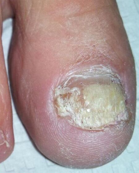 Hongo en los pies
