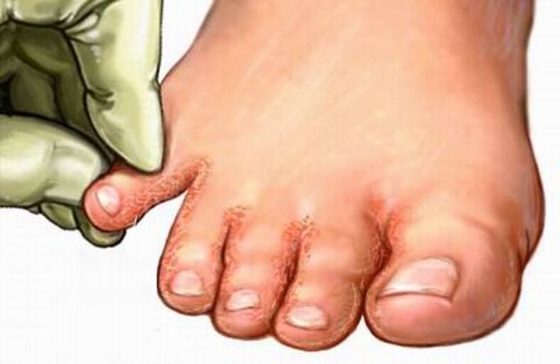 Hongo en los pies
