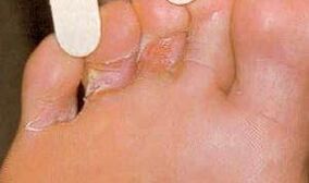 Heridas de donación para la micosis del pie
