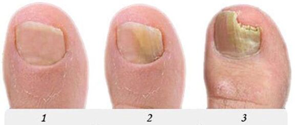 El proceso de desarrollar hongos en el pulgar