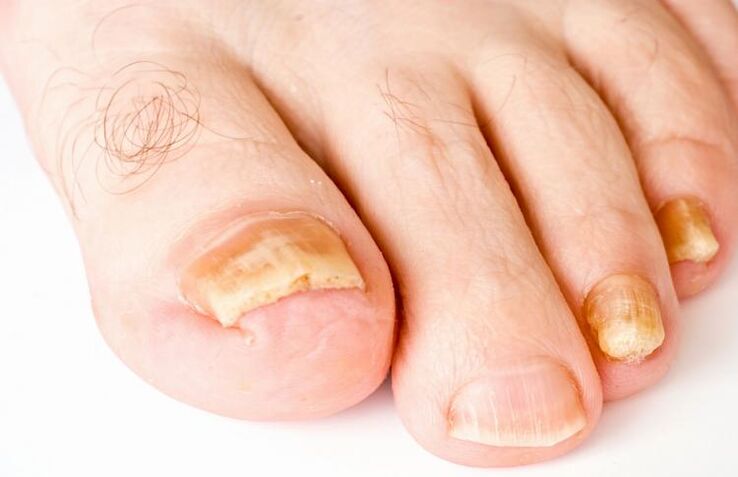 Las uñas de los pies amarillas son causadas por hongos.