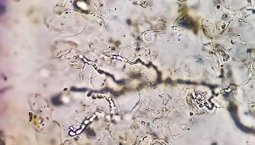 Hongos bajo el microscopio la causa del desarrollo de micosis del pie. 